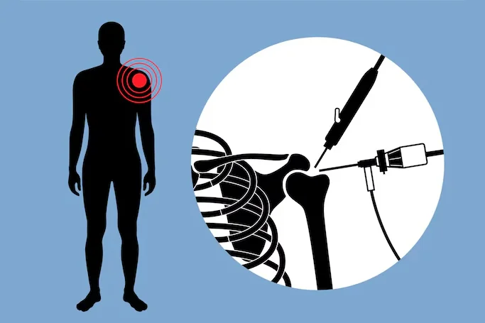 Arthroscopy Surgery for Rotator Cuff Repair