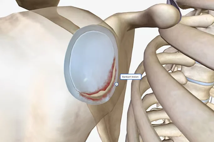 Arthroscopy Surgery for Bankart Repair