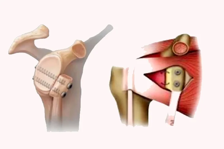 Latarjet Procedure