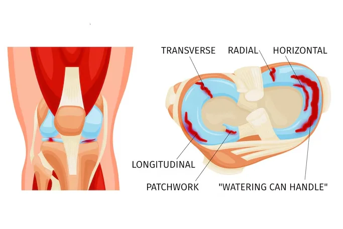 Knee Arthroscopy