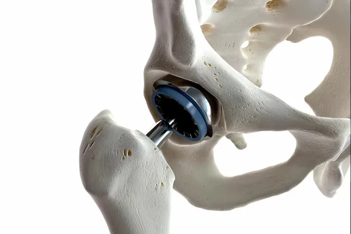 Hip Replacement Surgery